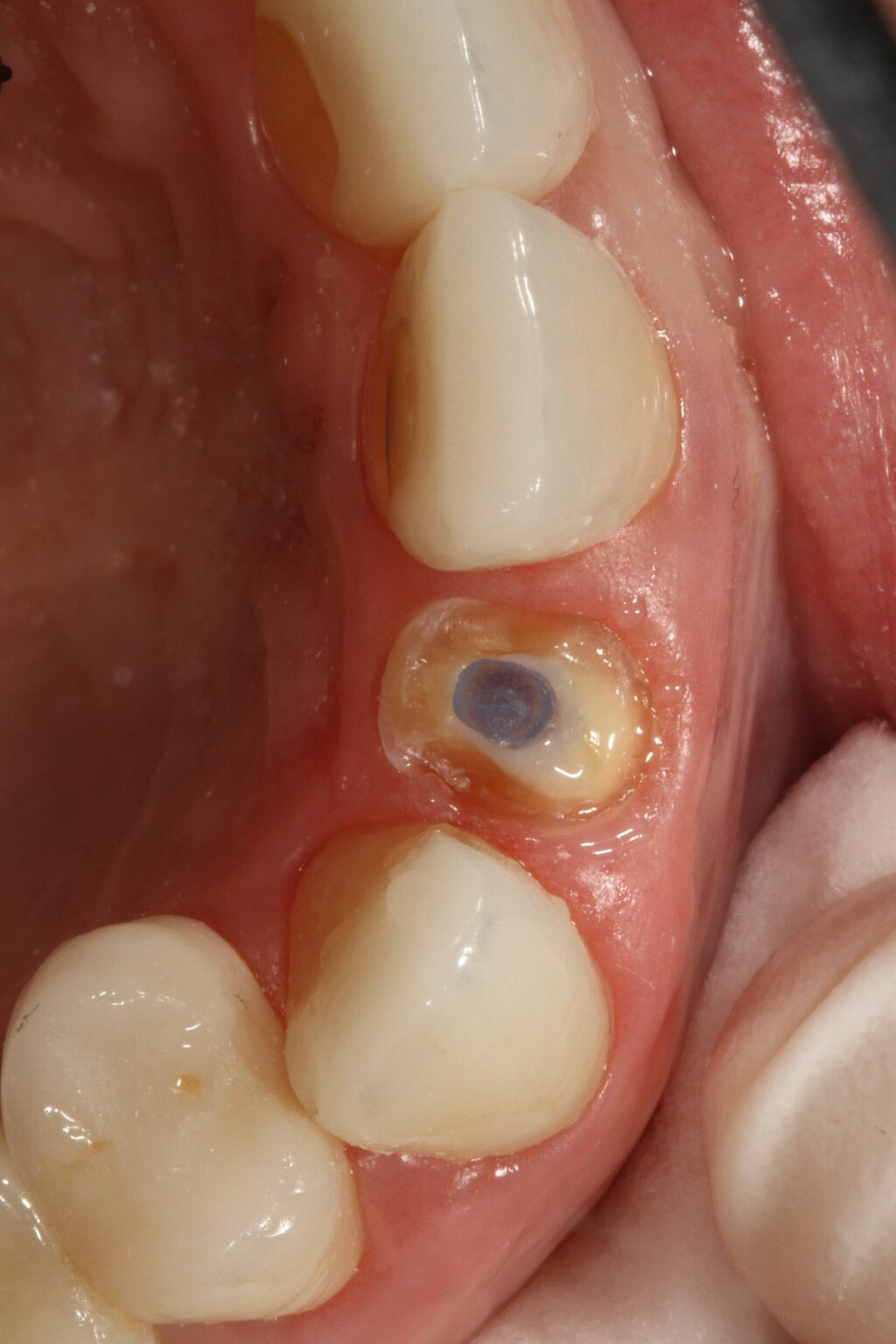 Kit Macro - Lock Oval - Dental Link