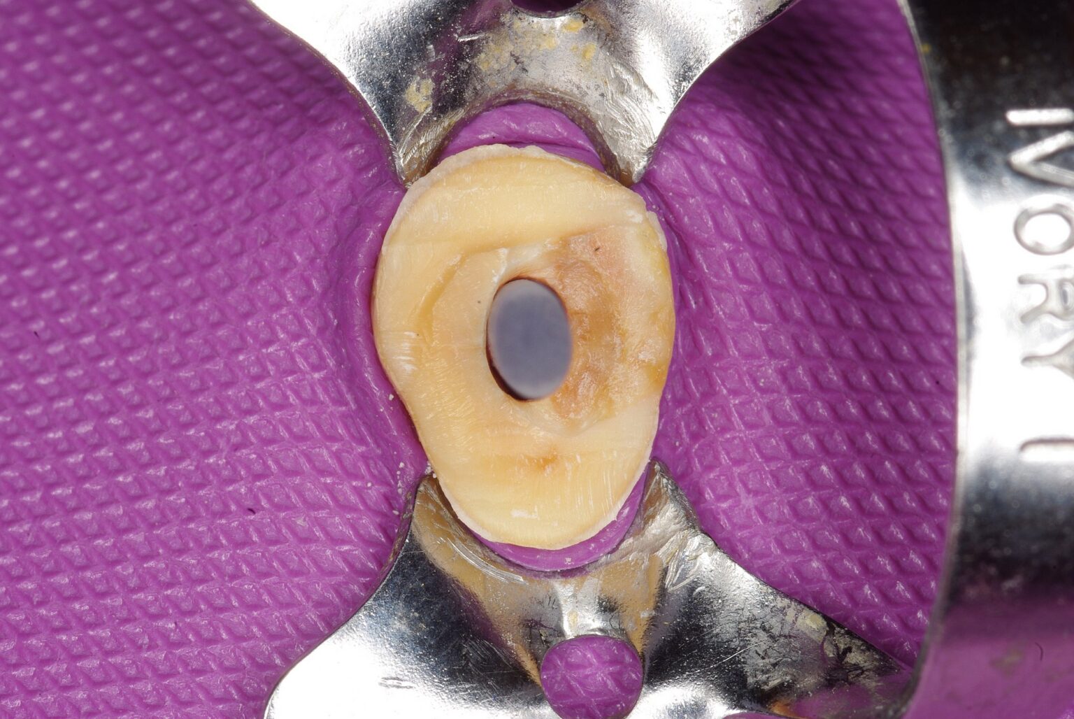 Pernos Macro-Lock Oval - Blister - Dental Link